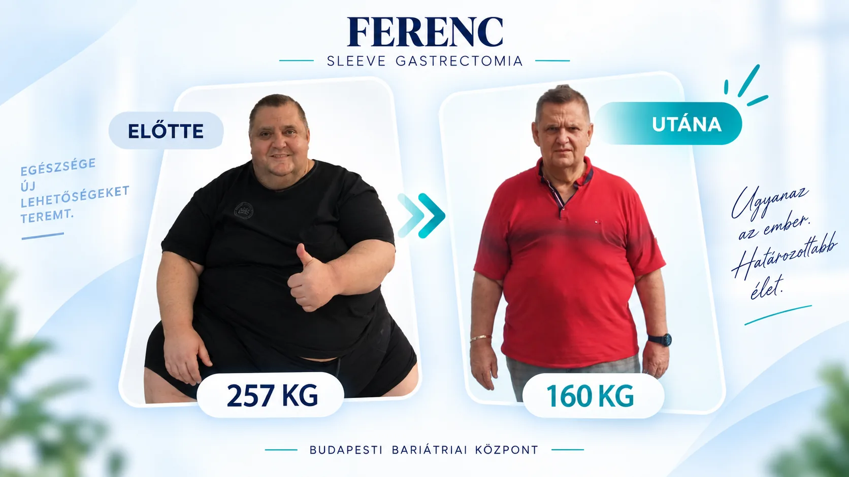 Túlsúlycsökkentő műtét előtte-utána: Ferenc, Sleeve gastrectomia, 257 kg → 160 kg